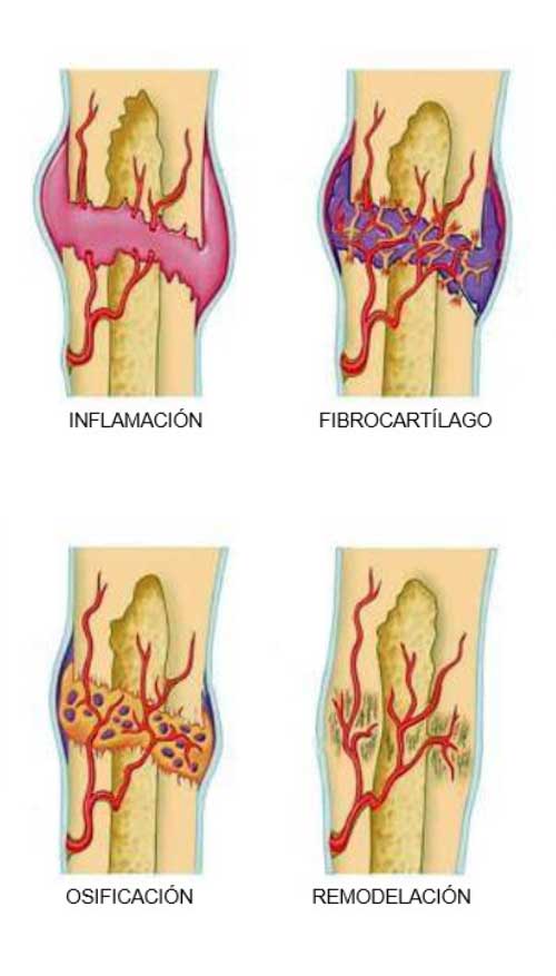 Consolidación de Fracturas