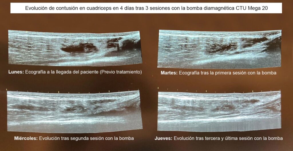 Rotura Fibras - Bíceps Femoral - Bomba Diamagnética Zaragoza