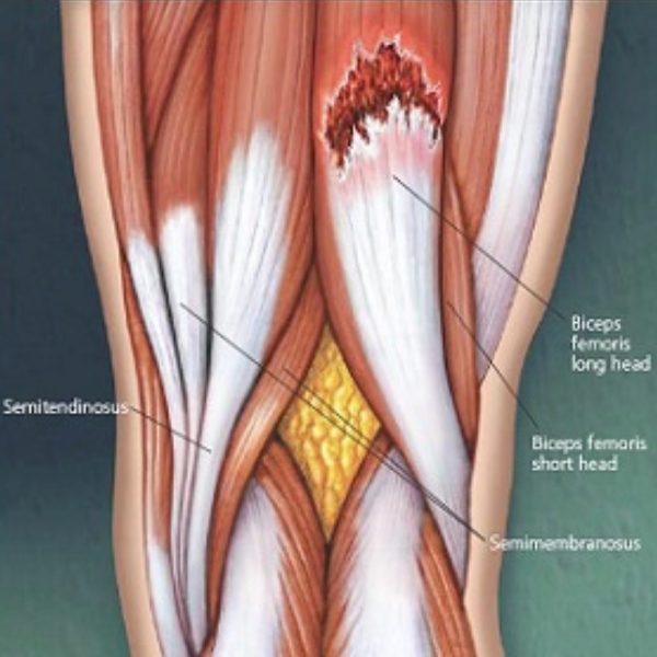 Rotura Fibras - Bíceps Femoral - Tratamiento Zaragoza